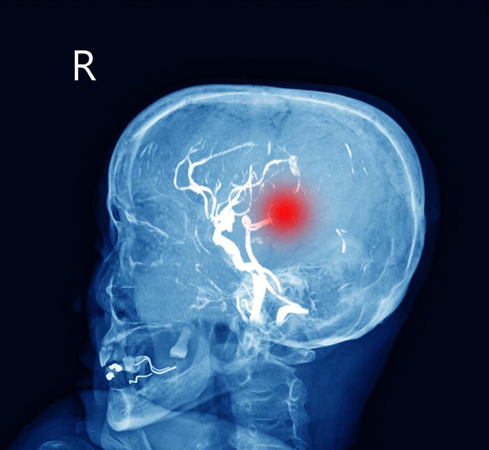 Patologie Neurovascolari